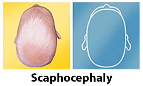 My Favourite Physio | scaphocephaly-500×300