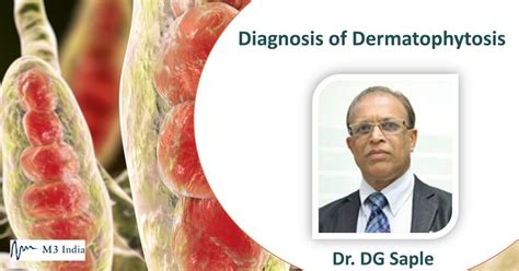 Exclusive series: Diagnosis of Dermatophytosis- Dr. DG Saple