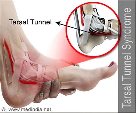 Tarsal Tunnel Syndrome Exercises