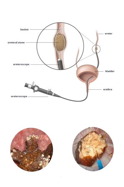 LASER Treatment In Urology – Bangalore Advanced Urology