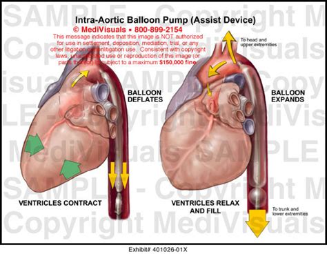 Intra-Aortic Balloon Pump (Assist Device) Medical Exhibit Medivisuals