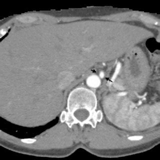 Celiac trunk angiography shows stenosis and a small pseudoaneurysm of ...