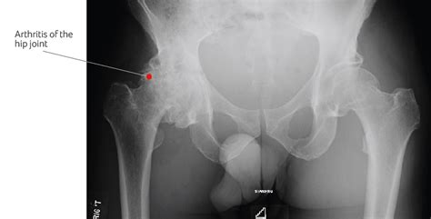 Osteoarthritis of the Hip and how hip pain is treated at SSC.