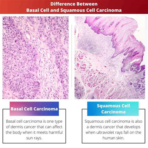 Basal Cell Versus Squamous Cell