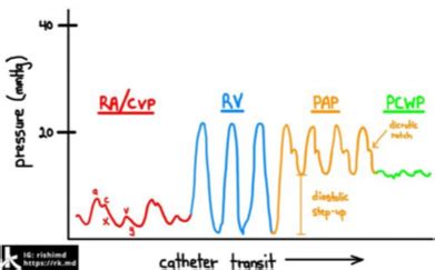 Diagram of Pulmonary Artery Catheter | Quizlet