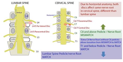 Cervical Radiculopathy - Spine - Orthobullets