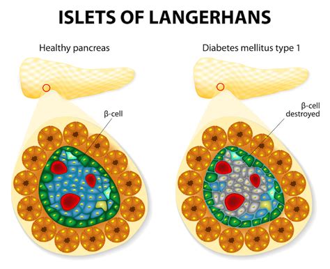 Long-Sought ‘Attack’ Signal in Type 1 Diabetes Identified | Exosome RNA