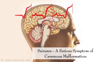 Cavernous Malformation - Causes, Symptoms, Treatment, Prevention