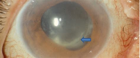 Understanding Endophthalmitis After Cataract Surgery: What Pharmacists ...