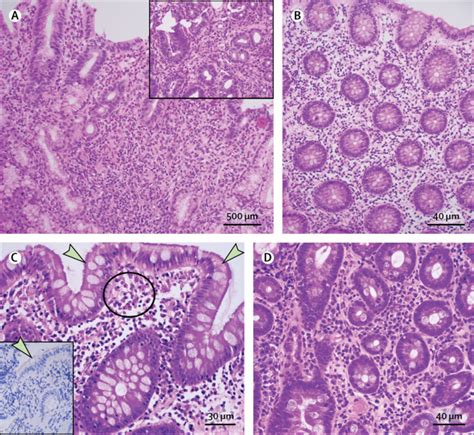 Eosinophilic gastroenteritis and other eosinophilic gut diseases distal ...