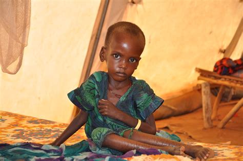 A malnourished child in an MSF treatment tent in Dolo Ado,… | Flickr