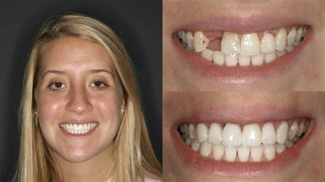 Teeth Veneers Before And After