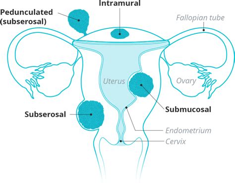 What Is a Subserosal Fibroid? - Responsum for Fibroids