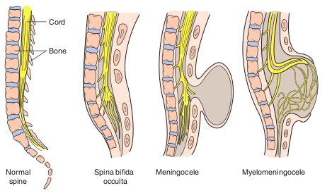 Spina Bifida 101 – Evies Warriors