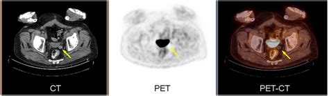 Frontiers | Peritoneal Mouse as Detected on 18F-FDG PET-CT | Oncology