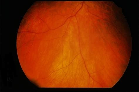 Plaquenil Toxicity - Retina Image Bank