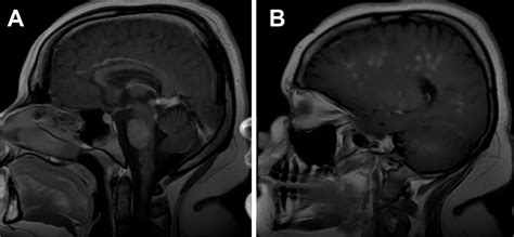 Clippers Syndrome Radiology - References In Clippers Syndrome Case ...