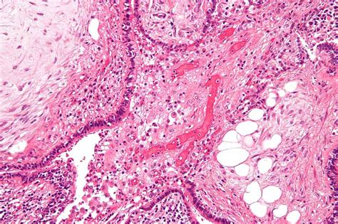 Symptoms, Causes, and Treatment for Hamartoma Tumors