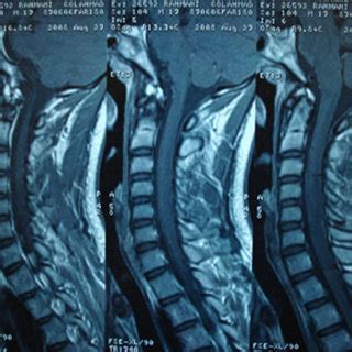 Abnormal Neck Mri Cervical Spine