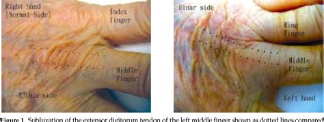 Figure 3 from Boxer'S Knuckle of Non-Boxer Patients | Semantic Scholar