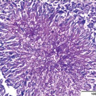 Fungal aggregate in bone tissue (PAS stain). | Download Scientific Diagram