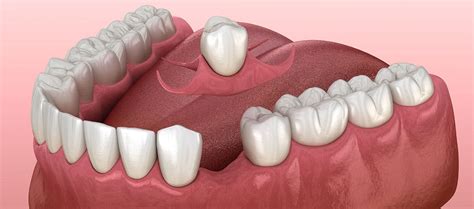 Single Tooth Denture Options