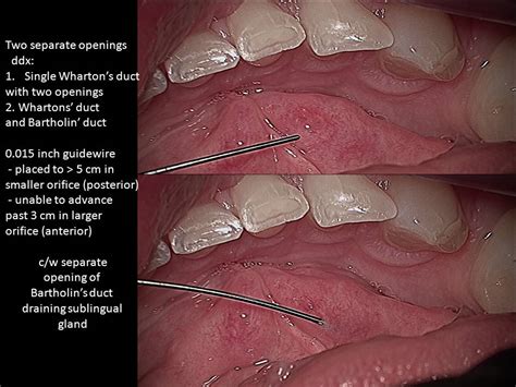 Submandibular Stone and Bartholin's duct | Iowa Head and Neck Protocols