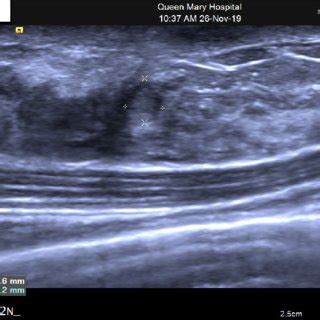 Right breast 1 o'clock position, 2 cm from nipple: deep to the skin... | Download Scientific Diagram