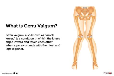 Genu Valgum: Causes, Symptoms, Treatment and Cost