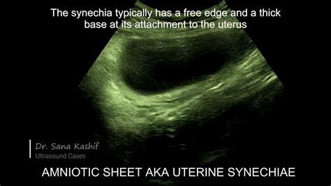 AMNIOTIC SHEET, CHORIOAMNIOTIC SEPARATION, UTERINE SYNECHIAE, AMNIOTIC SHEET IN EARLY PREGNANCY ...