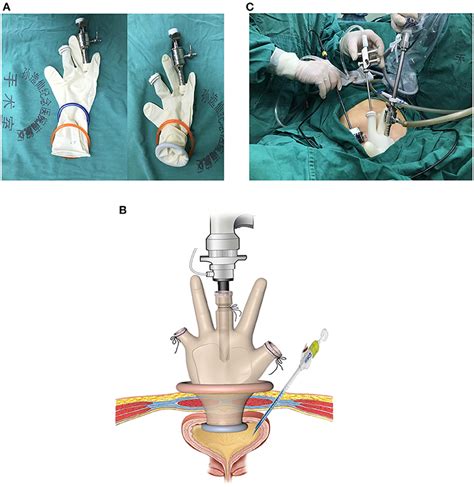 Frontiers | Suprapubic Transvesical Repair of Vesicovaginal Fistula ...