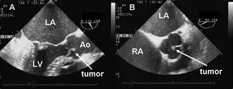 Aortic Papillary Fibroelastoma Detected by Transesophageal Echocardiography - Journal of ...