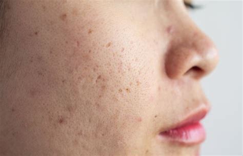 Ask a Dermatologist: How to Get Rid of Pitted Acne Scars