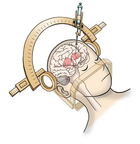 Stem cells to be transplanted into brains of Parkinson's patients in ...