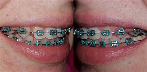 more-teal-braces – Braces Explained