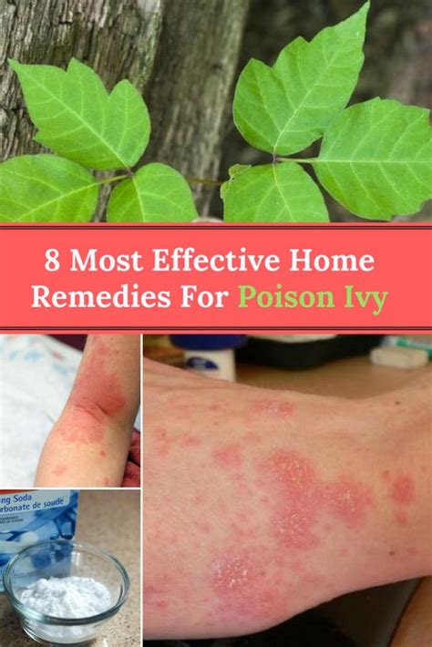 Poison Ivy Home Remedies: 8 Most Effective Remedies For Poison Ivy - Home and Gardening Ideas