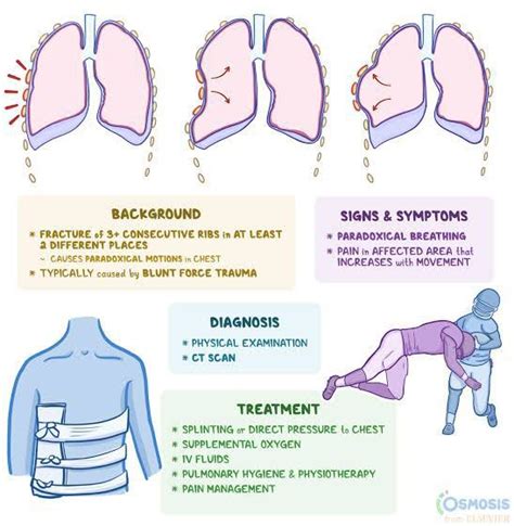 Symptoms of flail chest - MEDizzy