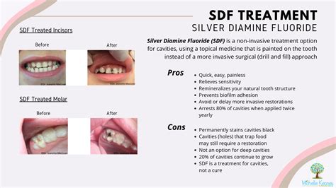 Silver Diamine Fluoride (SDF) | Arlington, Virginia | Michelle Keaney Flanagan, DMD