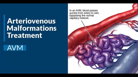 Arteriovenous Malformations Treatment - YouTube