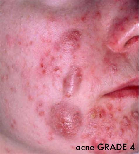 Acne Grade Four