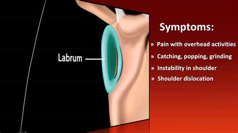 USC Athletics Injury Report - Shoulder Labral Tear - YouTube