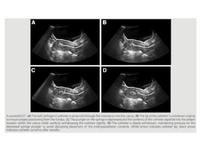 Embryo Transfer: A Critical Step in the IVF Process