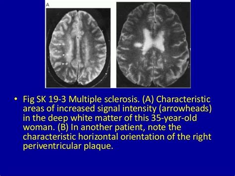 19 periventricular white matter abnormalities on magnetic resonance