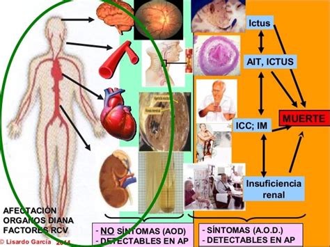 Lesión de Organos diana en la HTA. Como detectarlas desde la Atención…