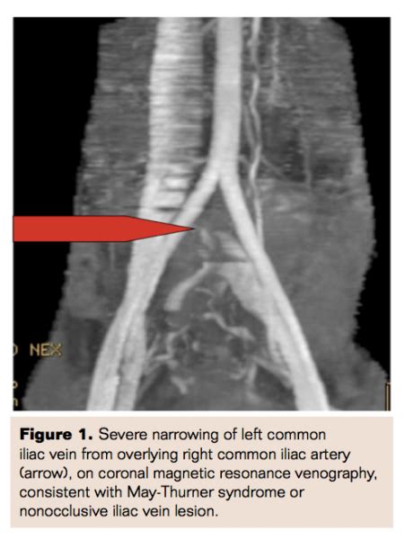 Venogram Venous Occlusive Disease