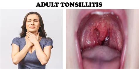 ADULT TONSILLITIS: Symptoms, Diagnosis, Treatment, and Care