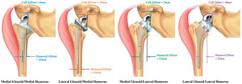 JFMK | Free Full-Text | Reverse Shoulder Arthroplasty Biomechanics