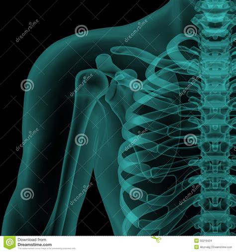 X-ray Of The Human Shoulder Joint. Fracture In The Neck Of The Right Humerus. Osteoarthritis Of ...