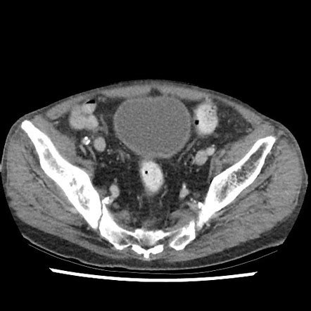 Right hemipelvis metastases simulating Paget disease | Radiology Case | Radiopaedia.org