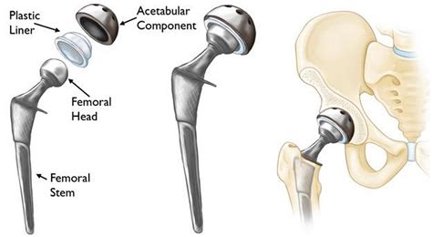 Hip Replacement Surgery- Recovery Time, Alternatives, Risks